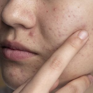Acne on the face